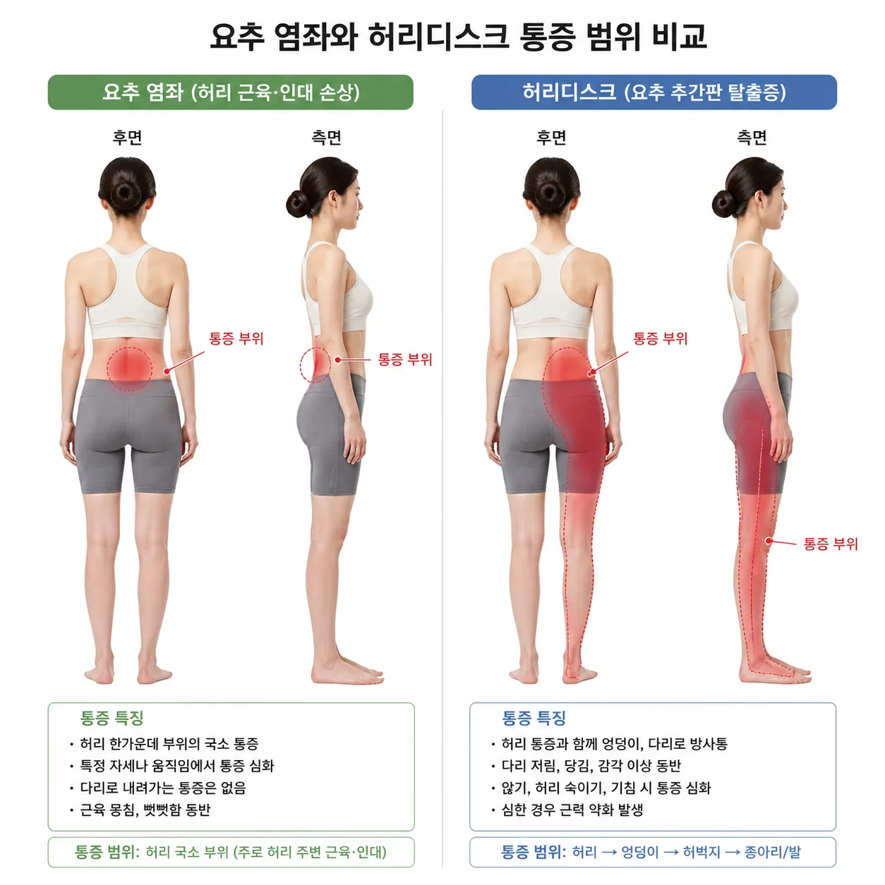 요추 염좌와 허리디스크 통증 범위 비교 일러스트