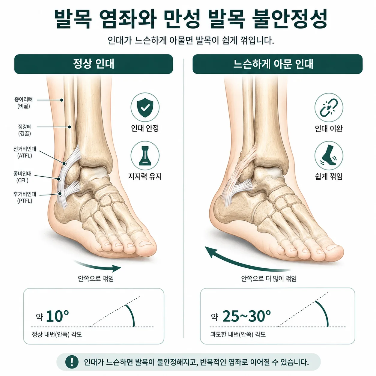 발목 염좌 방치로 느슨해진 인대와 정상 인대의 비교