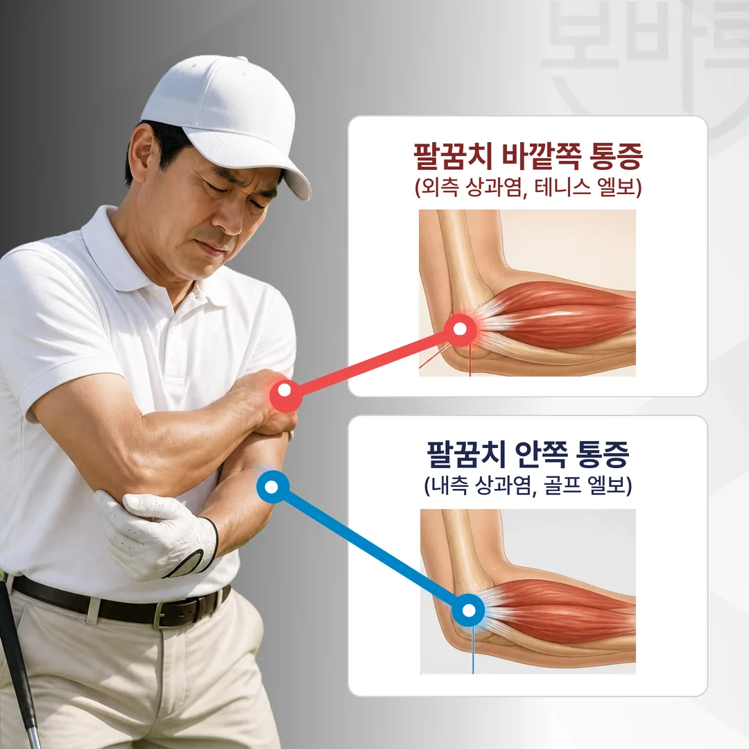 골프엘보와 테니스엘보의 아픈 위치를 구분하는 팔꿈치 통증 일러스트