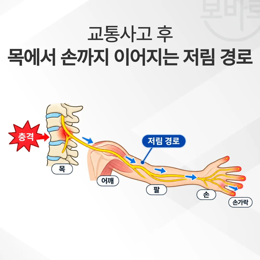 교통사고 후 목에서 손까지 이어지는 저림 경로 개념도
