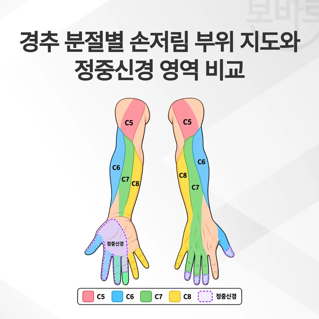 경추 분절별 손저림 부위 지도와 정중신경 영역 비교