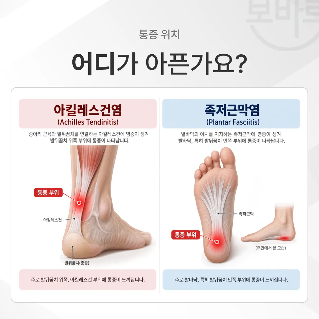 아킬레스건염은 발꿈치뼈 뒤쪽과 그 위쪽, 족저근막염은 발꿈치뼈 안쪽 바닥으로 통증 위치가 다르다는 것을 보여주는 개념도