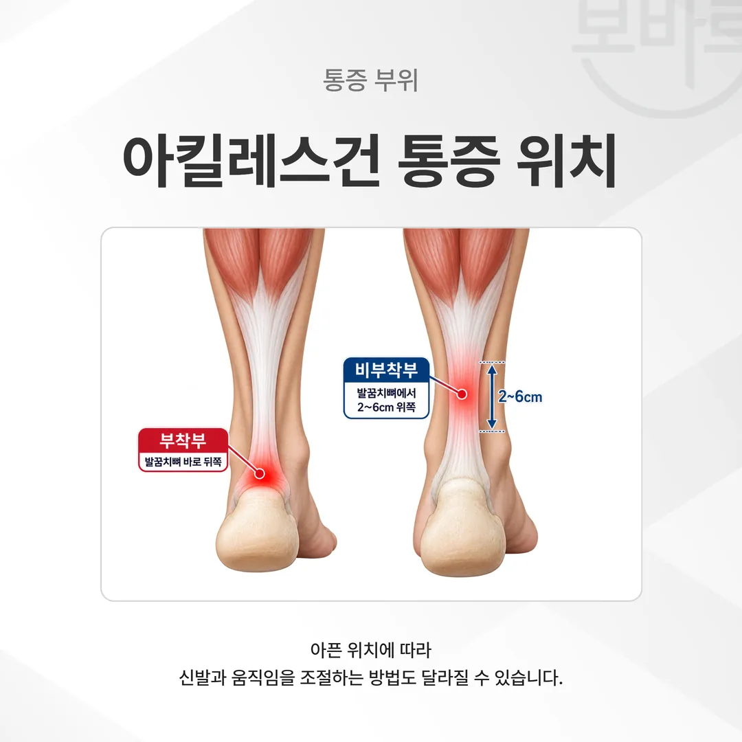 발꿈치뼈 뒤쪽의 부착부와 그 위 2~6cm 구간의 비부착부를 구분해 표시한 아킬레스건 구조 그림
